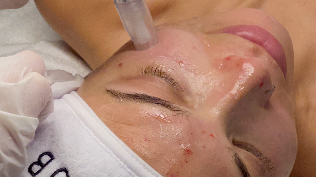 Microneedling in Richmond, Canada | Face Club
