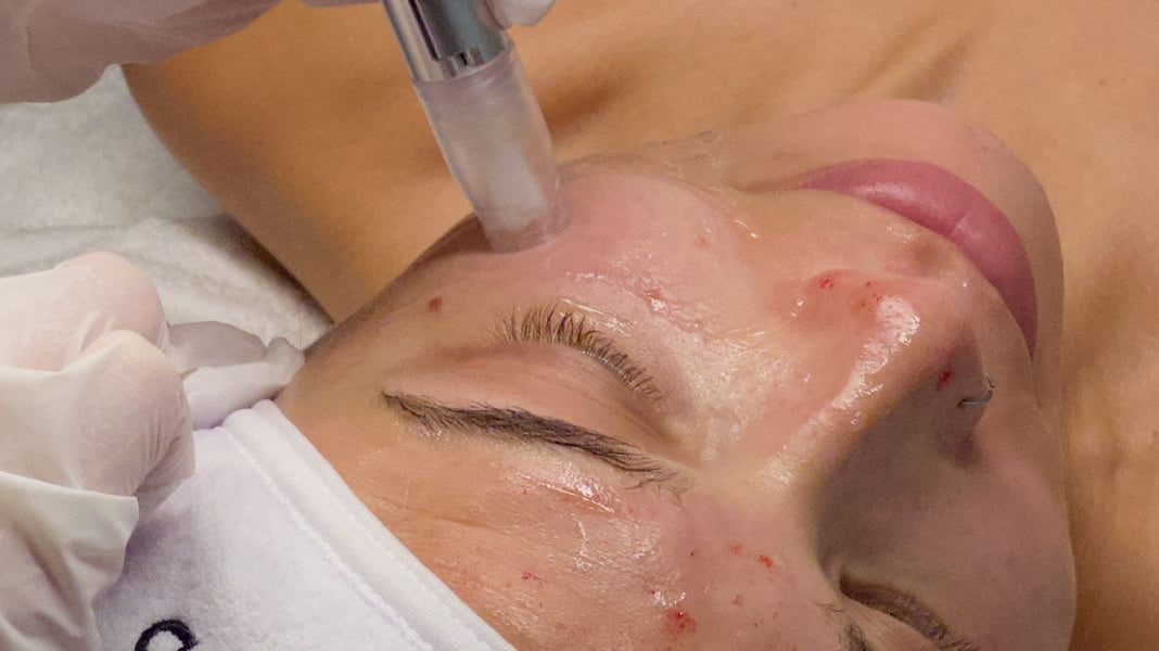 Face Club Microneedling Richmond, BC