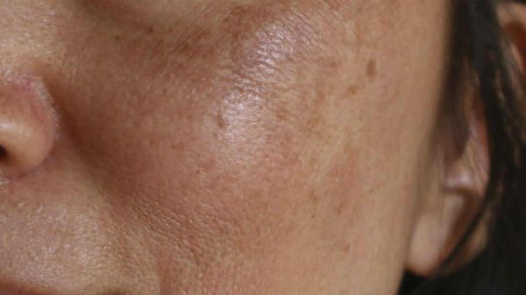 Illustration of melasma on the face showing dark, blotchy patches caused by hormonal changes, UV exposure, and overactive melanocytes