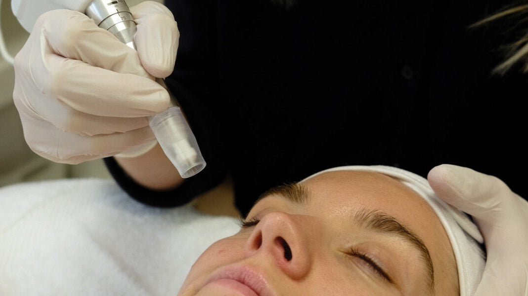 Microneedling in Vancouver, BC: Everything You Need to Know About This Transformative Facial Treatment