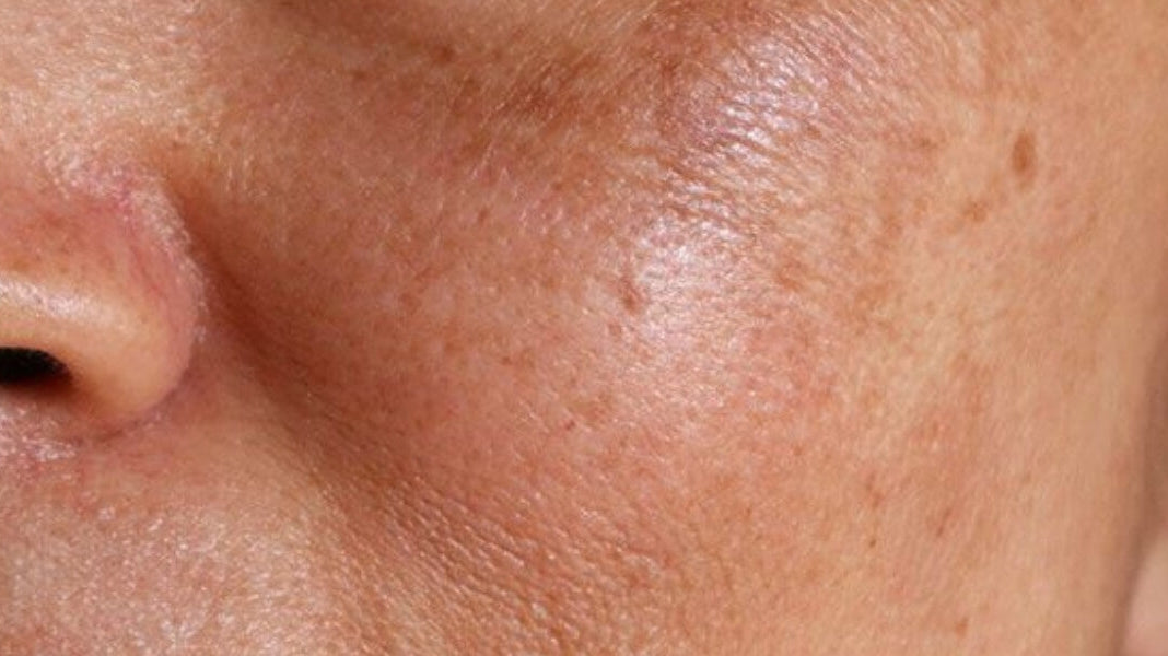 Hyperpigmentation: What Causes It and How to Treat It?