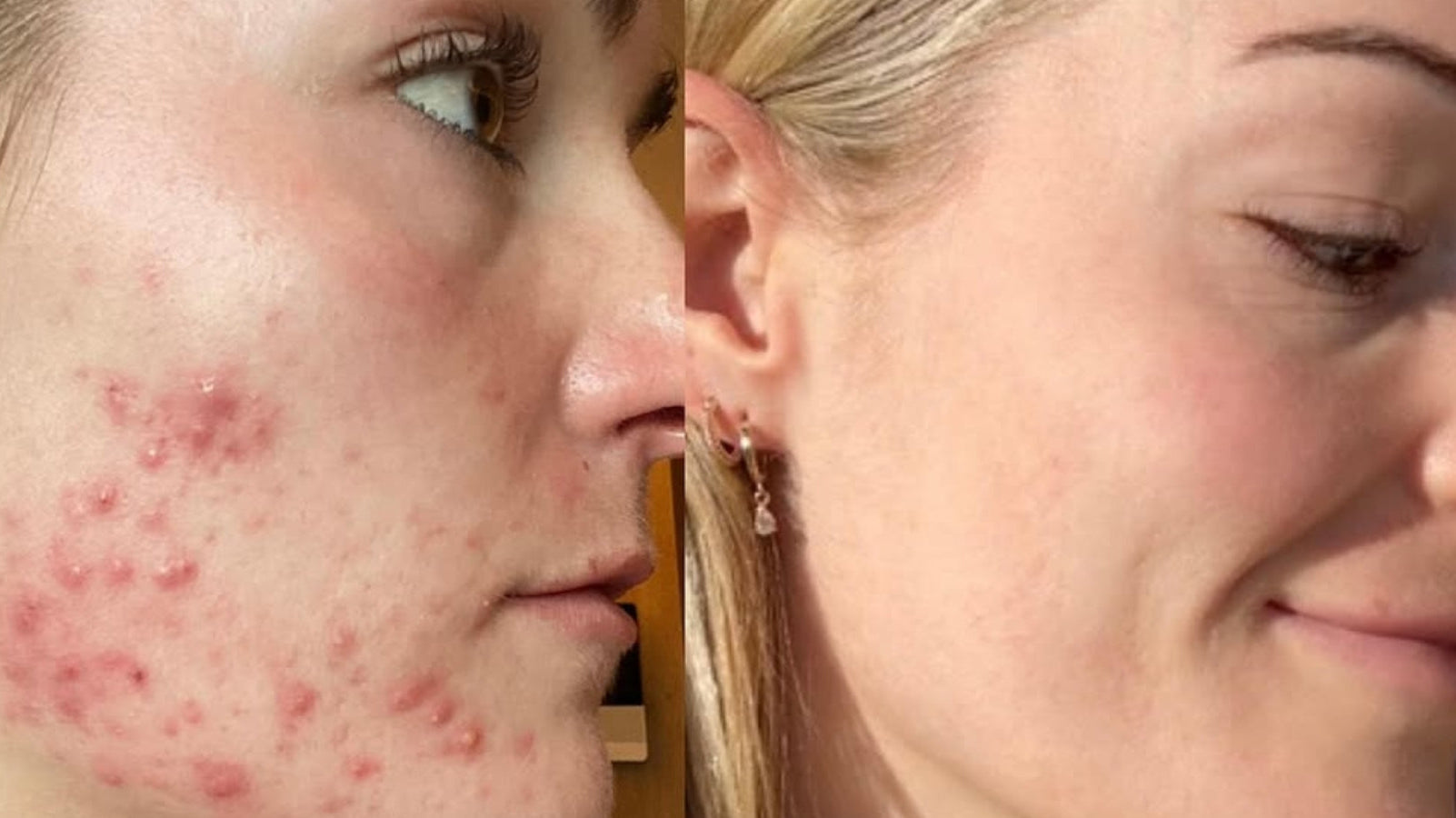 Stress and Acne: Understanding the Connection + How to Support Your Skin