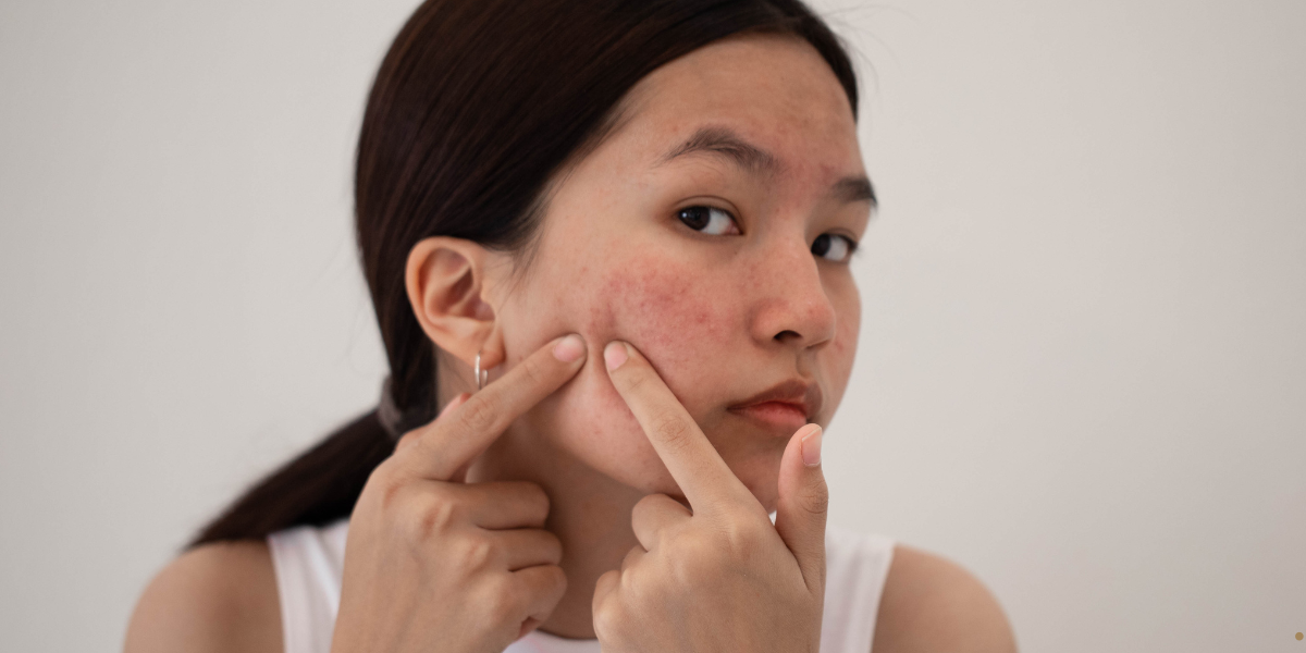 Hormonal Acne What Causes It And How To Treat It