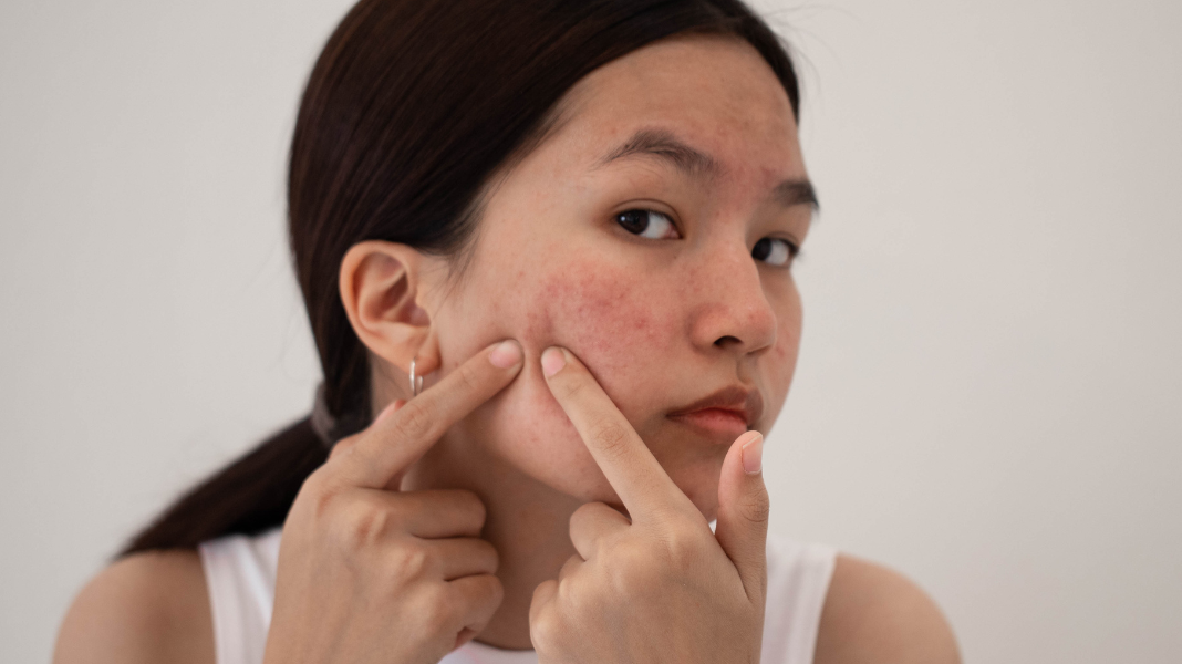 Hormonal Acne: What Causes It and How to Treat It