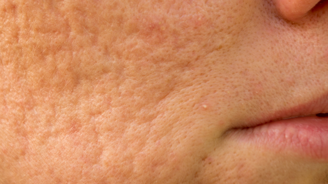 Acne Scars: Your Complete Guide