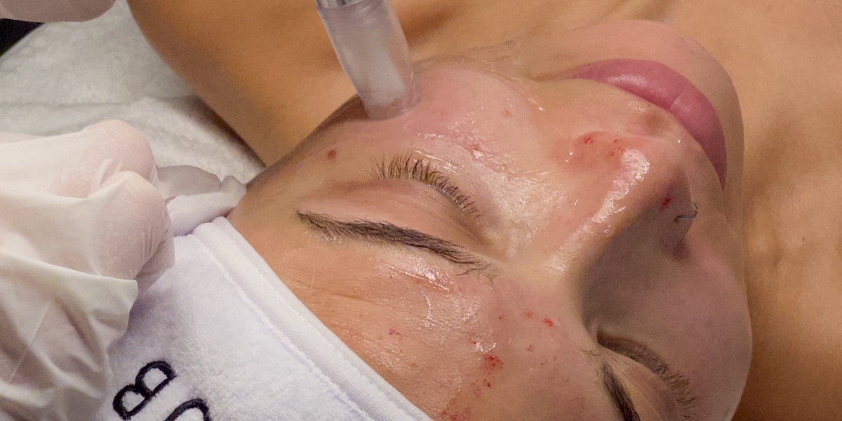Microneedling in Richmond, Canada | Face Club