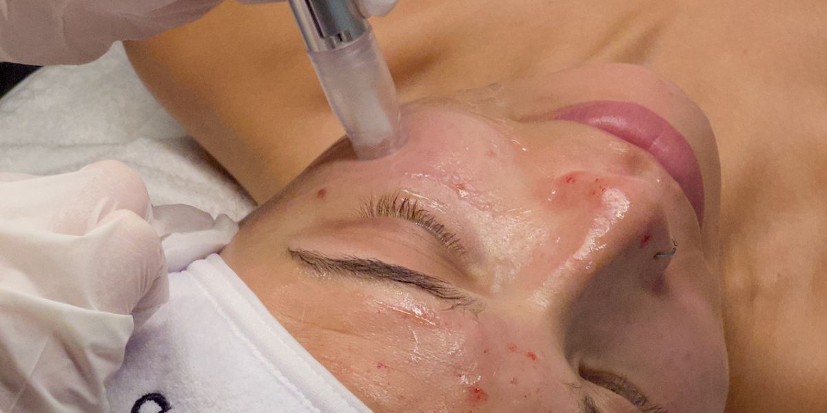 Face Club Microneedling Richmond, BC