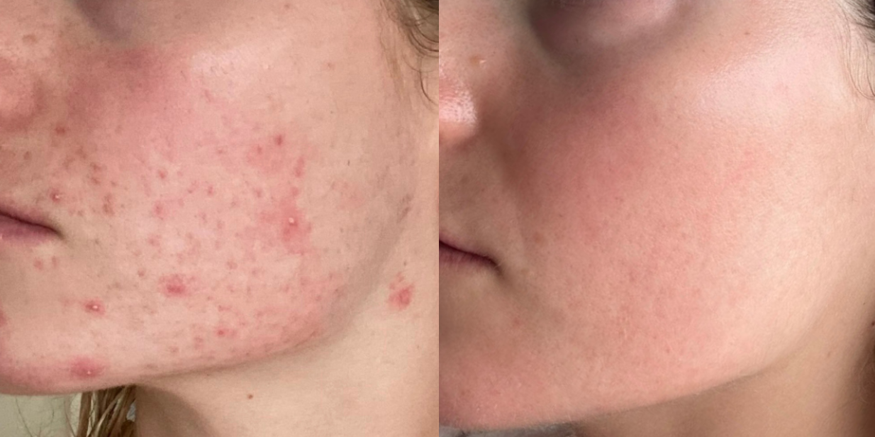 How to Treat Acne Scarring