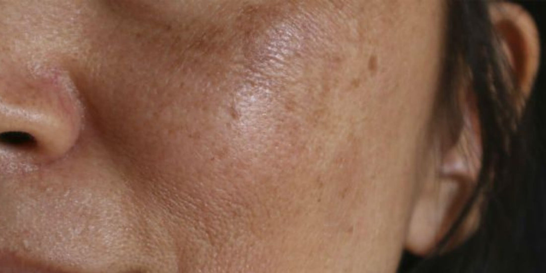 Illustration of melasma on the face showing dark, blotchy patches caused by hormonal changes, UV exposure, and overactive melanocytes