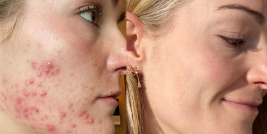 Stress and Acne: Understanding the Connection + How to Support Your Skin