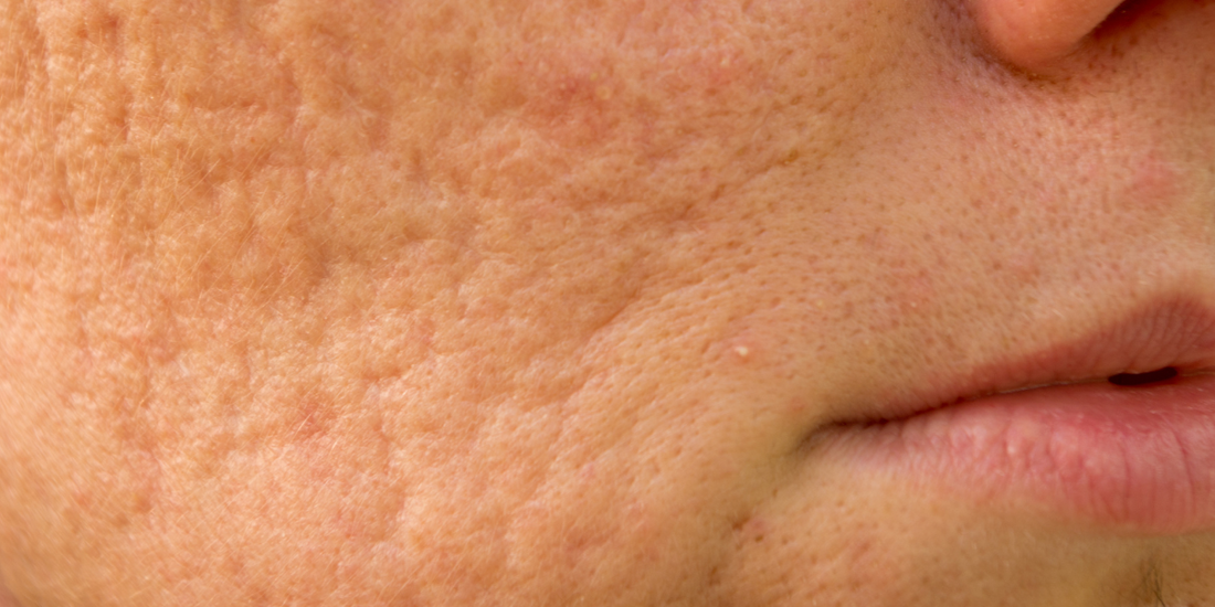 Acne Scars: Your Complete Guide