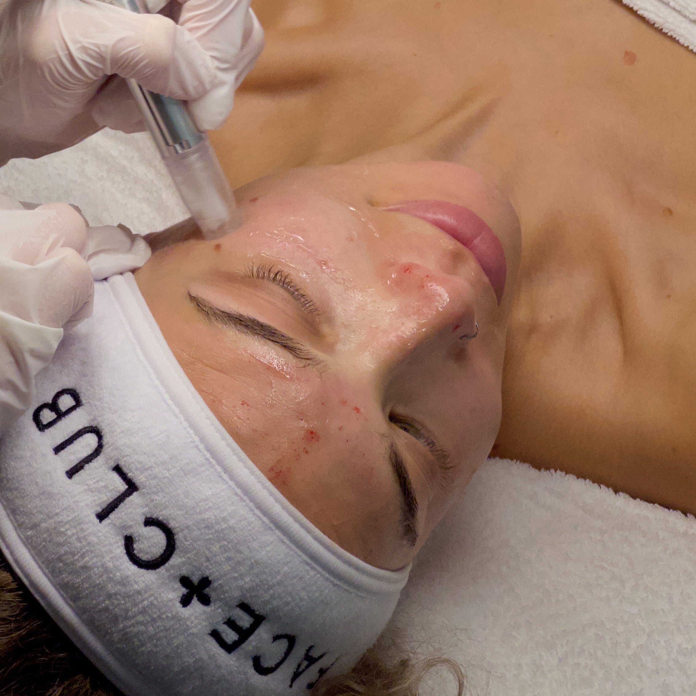 The Collagen Builder is a minimally invasive skin rejuvenation treatment designed to boost collagen production and enhance youthful skin. 
This facial uses Microneedling, or Collagen Induction Therapy, which stimulates your own wound repair response to form healthy collagen and elastin. - Best Microneedling Facial | Best Facial Studio Greater Vancouver | Best Facial Treatment Vancouver | Best Facial Massage Vancouver | Skin Care Centre Vancouver | Best Facial Treatment Richmond BC
